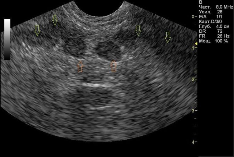 prostatitas pagal mano ultragarso rezultatus